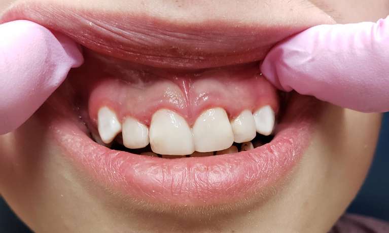 Composite-Fillings-After-Image