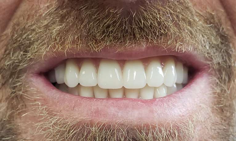 Upper-and-Lower-Dentures-After-Image