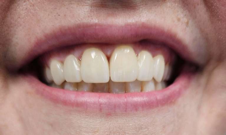 Smile-Transformation-with-Bridges-After-Image