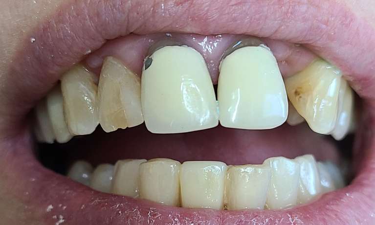 1-Bridge-Makeover-Before-Image