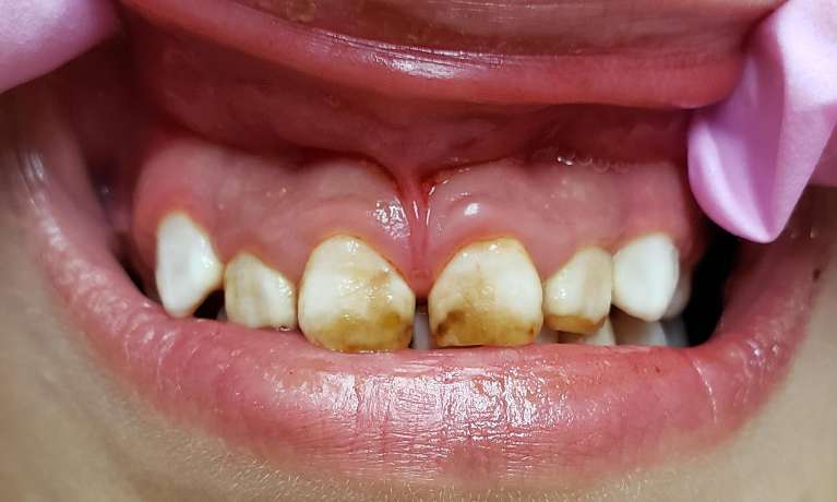 Composite-Fillings-Before-Image