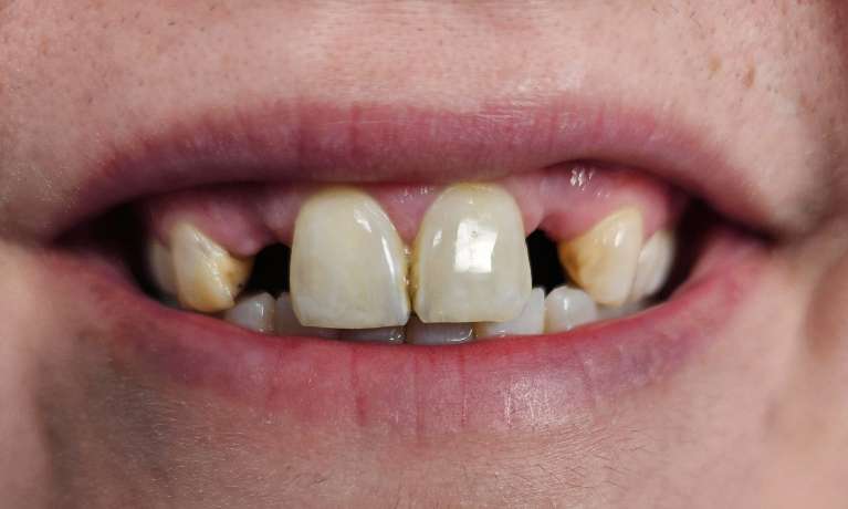 Smile-Transformation-with-Bridges-Before-Image